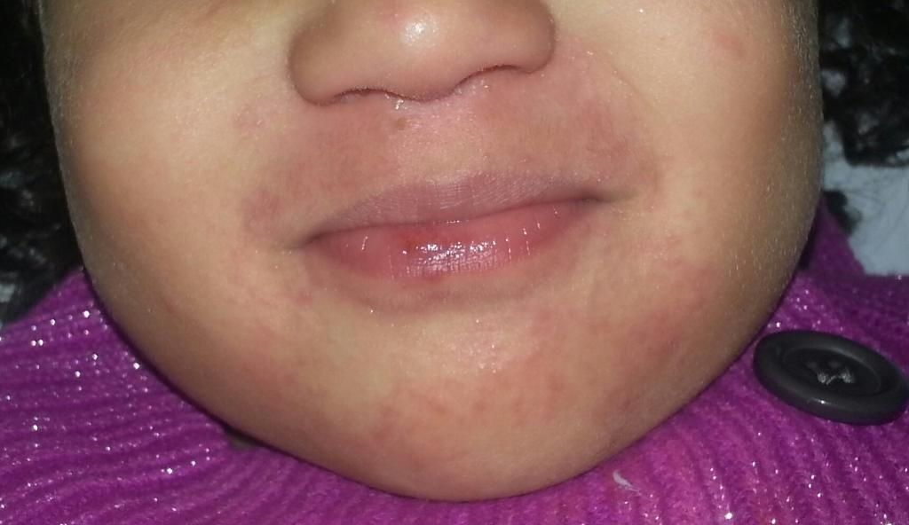 rash-around-mouth-babycenter