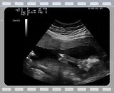 sonogram 5 weeks. for ultrasound - 5 weeks